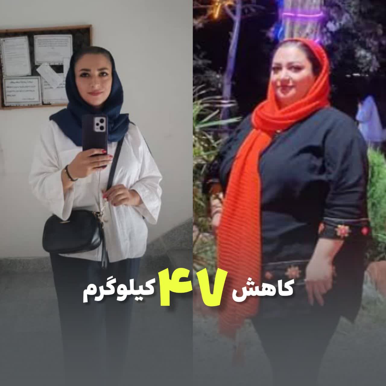 وزن اولیه 110 وزن بعدی 63 یک سال و نیم بعد مینی بای پس